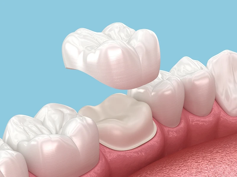 Dental Crowns and Bridges Dubai