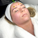 BioRePeel in Manchester for Acne-Prone Skin