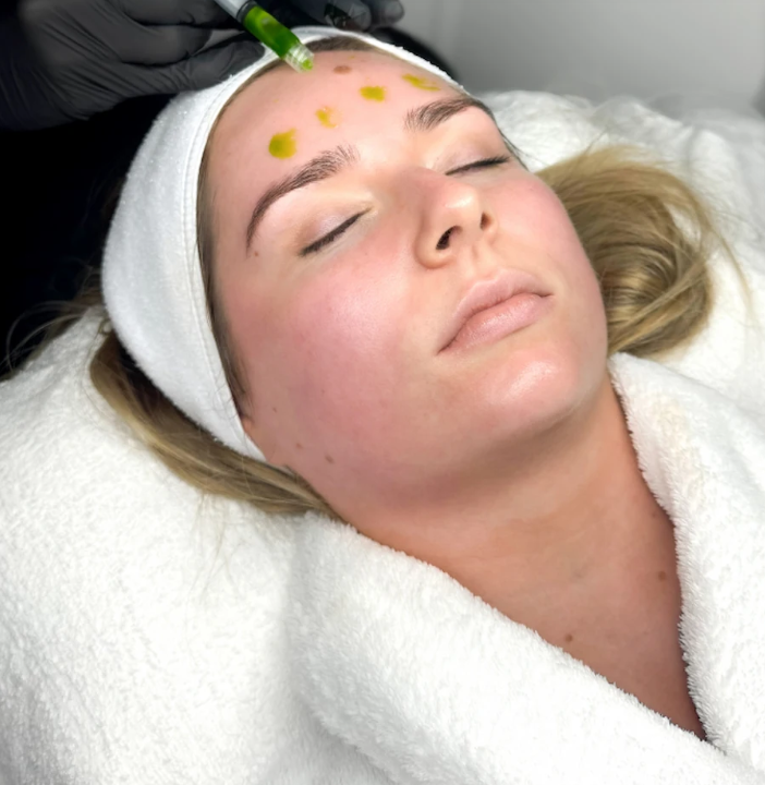 BioRePeel in Manchester for Acne-Prone Skin