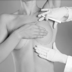 Breast Reduction in Dubai – Better Lifestyle, Better Health