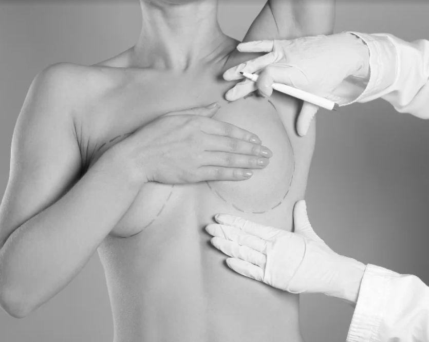 Breast Reduction in Dubai – Better Lifestyle, Better Health