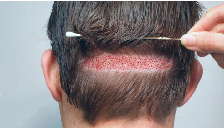FUE Hair Transplant Pakistan