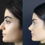Rhinoplasty in Dubai