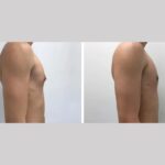 gynecomastia in dubai