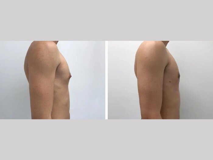 gynecomastia in dubai