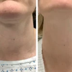 Best Aesthetic Clinic in dubai Radiofrequency (RF) Microneedling for Refined Skin