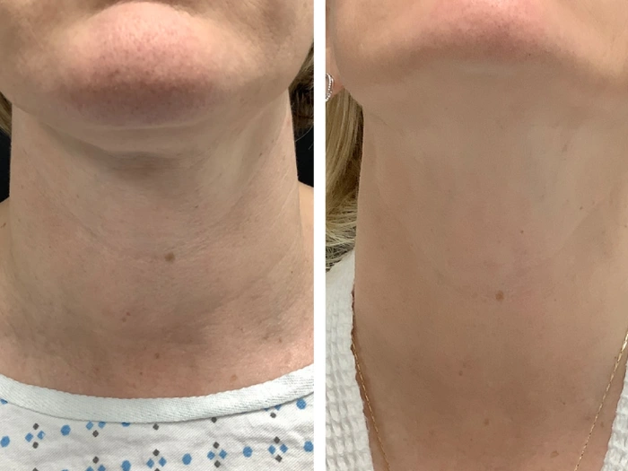 Best Aesthetic Clinic in dubai Radiofrequency (RF) Microneedling for Refined Skin