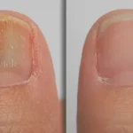 Laser Therapy for Toenail Fungus: How It Treats Infection