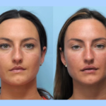 Thread Lift: Non-Invasive Facelift Solutions by the Best Doctors in Dubai