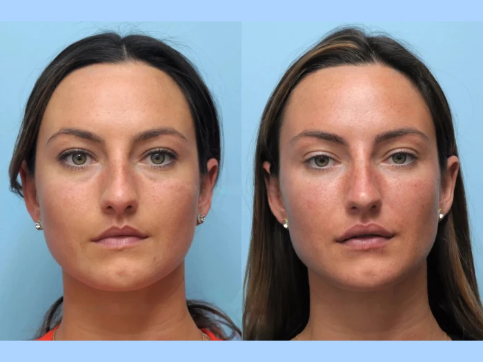 Thread Lift: Non-Invasive Facelift Solutions by the Best Doctors in Dubai