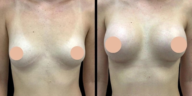 breast enhancement in Dubai